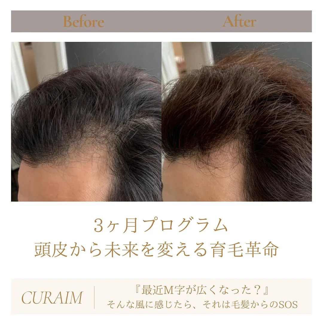 📸【「M字が広がってきた…」と感じたら、それは髪からのSOS...