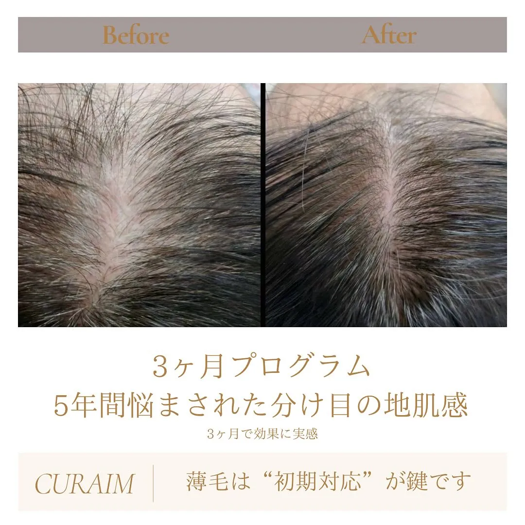 📍分け目の地肌感にサヨナラ！