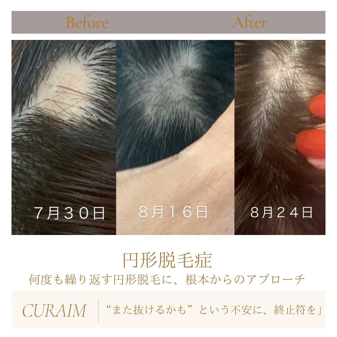 繰り返す円形脱毛症…