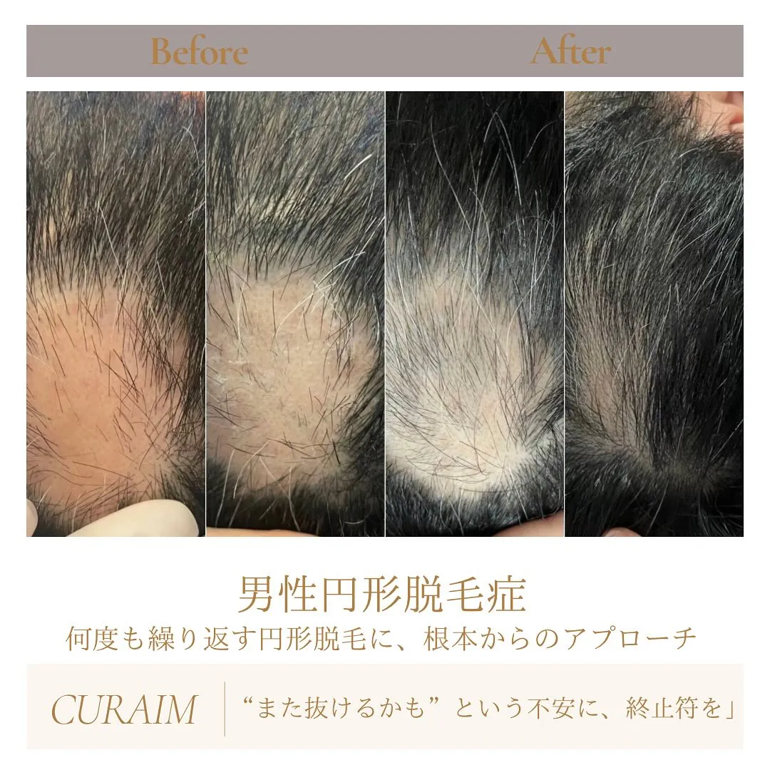 📍何度も繰り返す円形脱毛もう、終わらせよう。