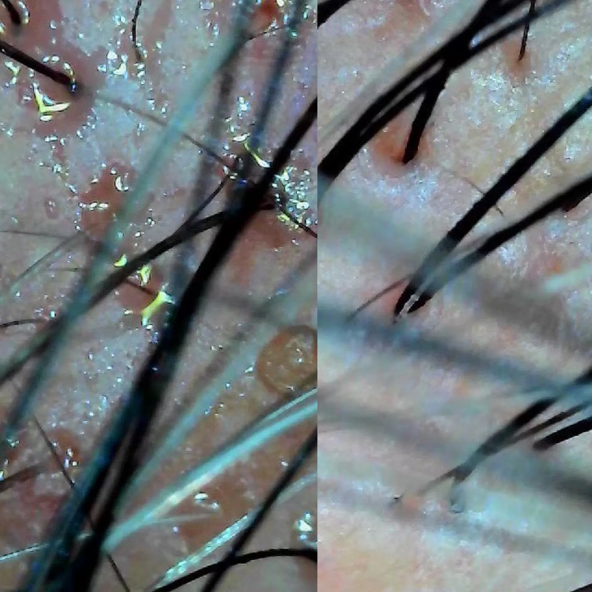 頭皮洗浄（ハイドロスプラッシュ）