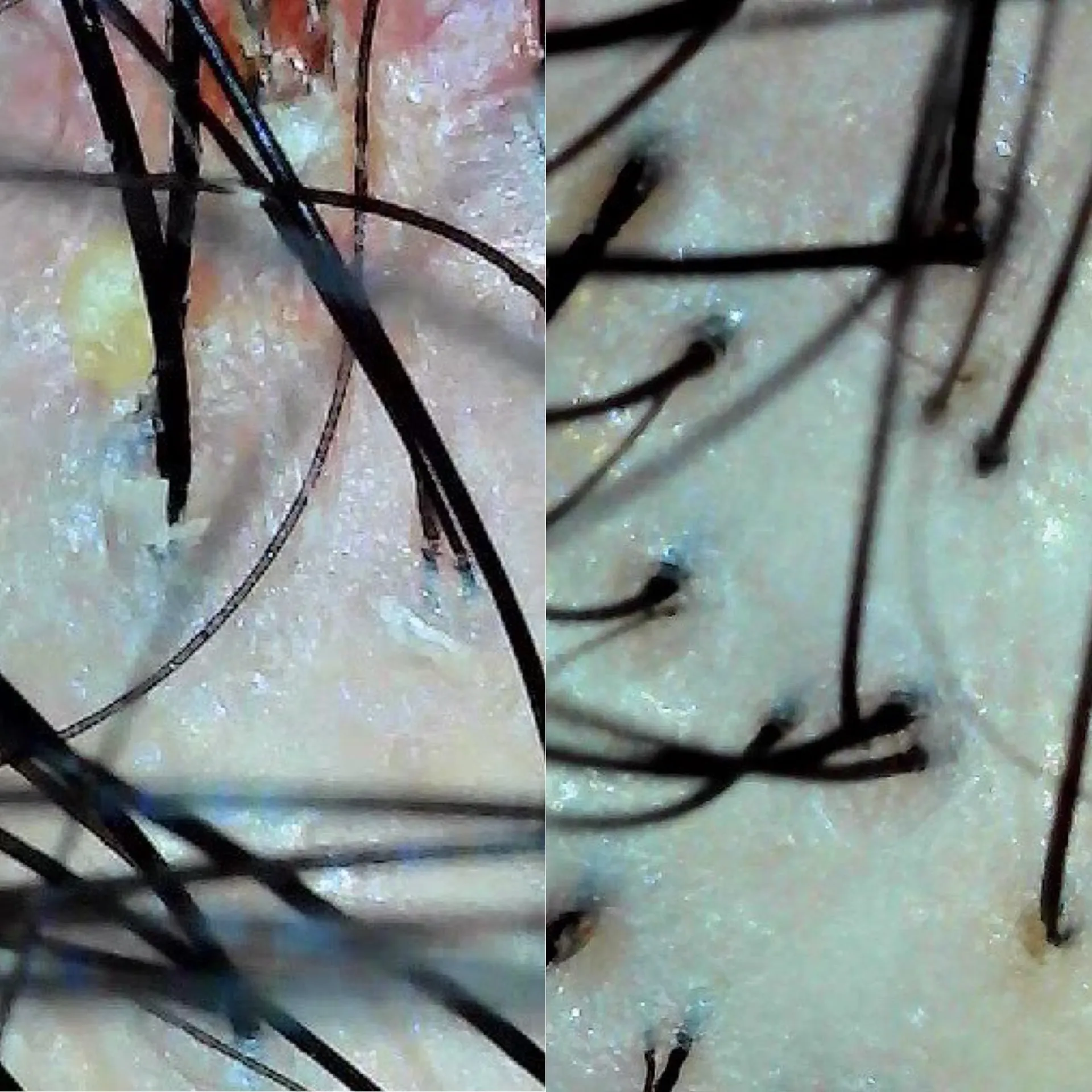 頭皮洗浄（ハイドロスプラッシュ）