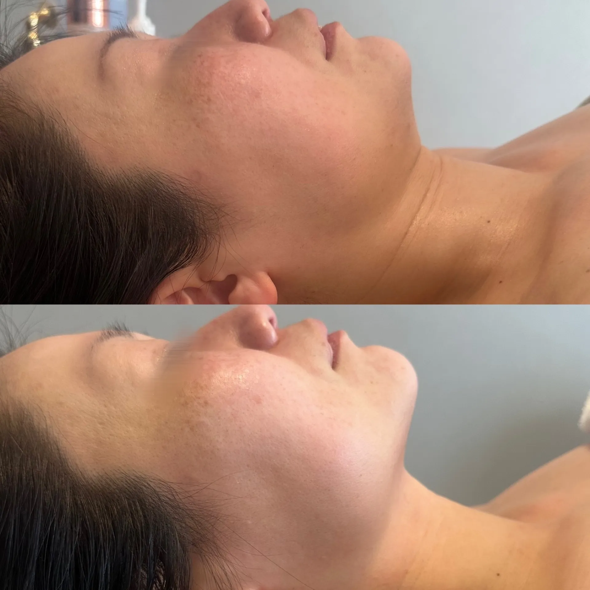 フィジオショット（小顔＆肌質改善）