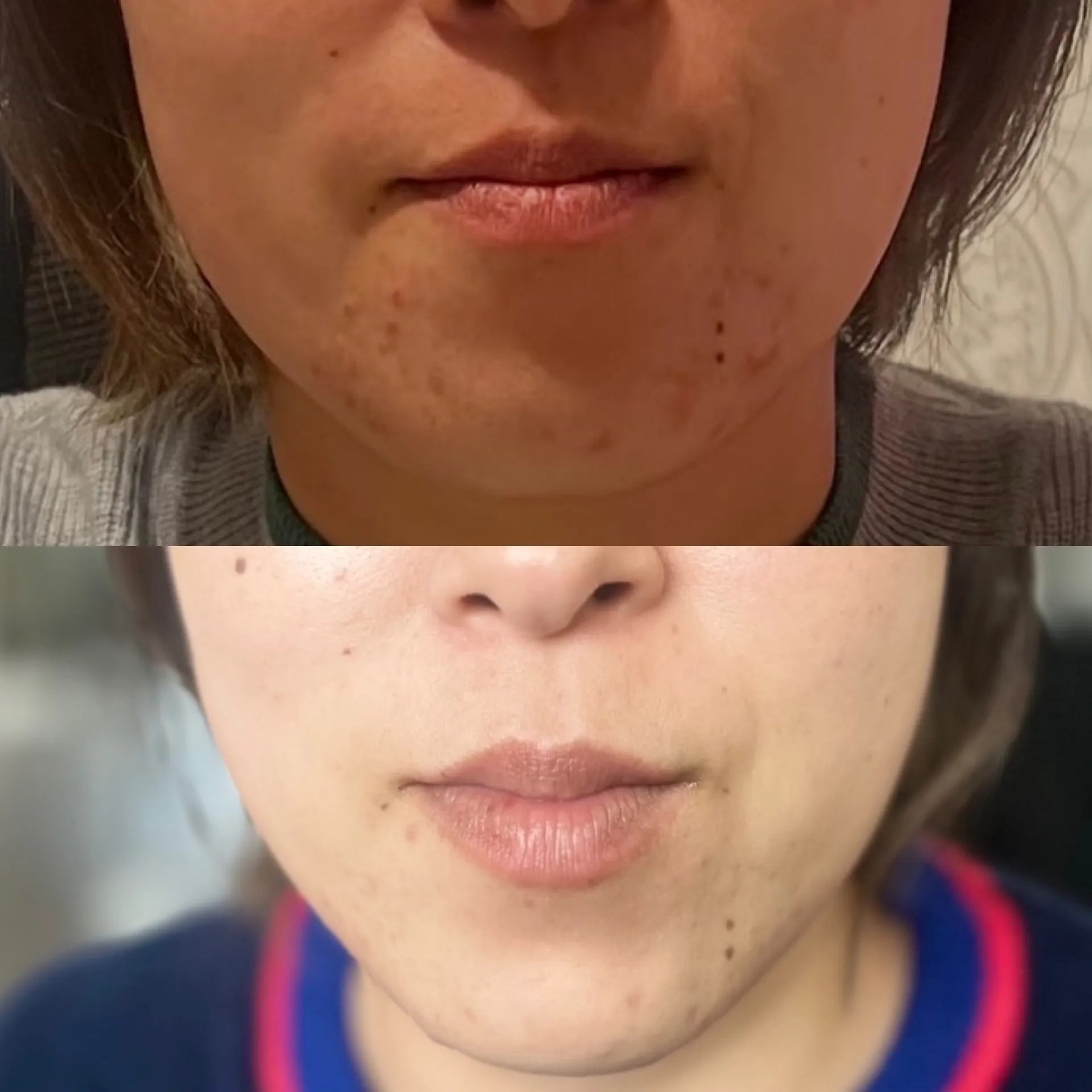 フィジオショット（小顔＆顎下ニキビ改善）