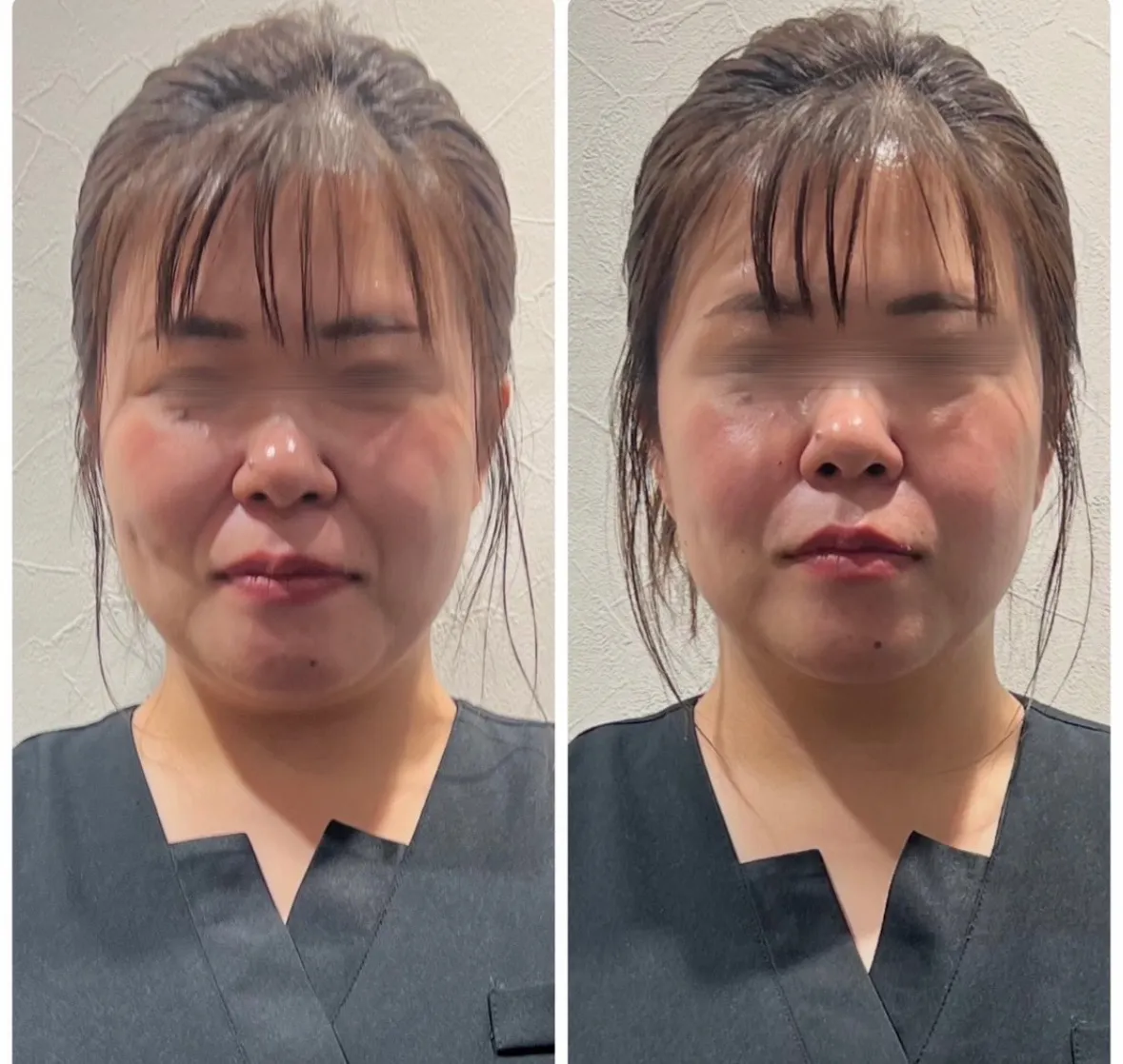 フィジオショット（小顔＆垂水改善&脂肪溶解）