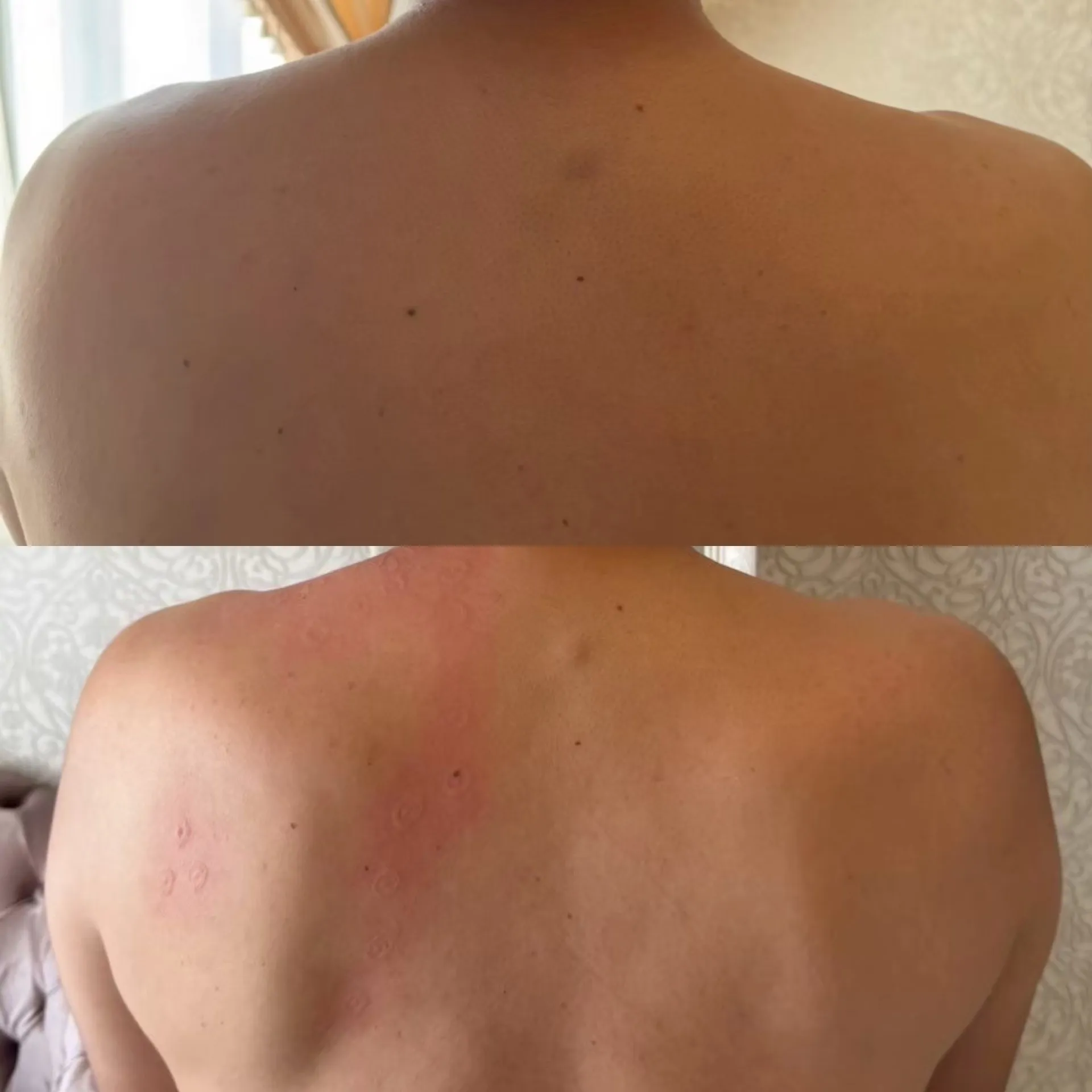 フィジオショット（肩甲骨、肩凝り改善）