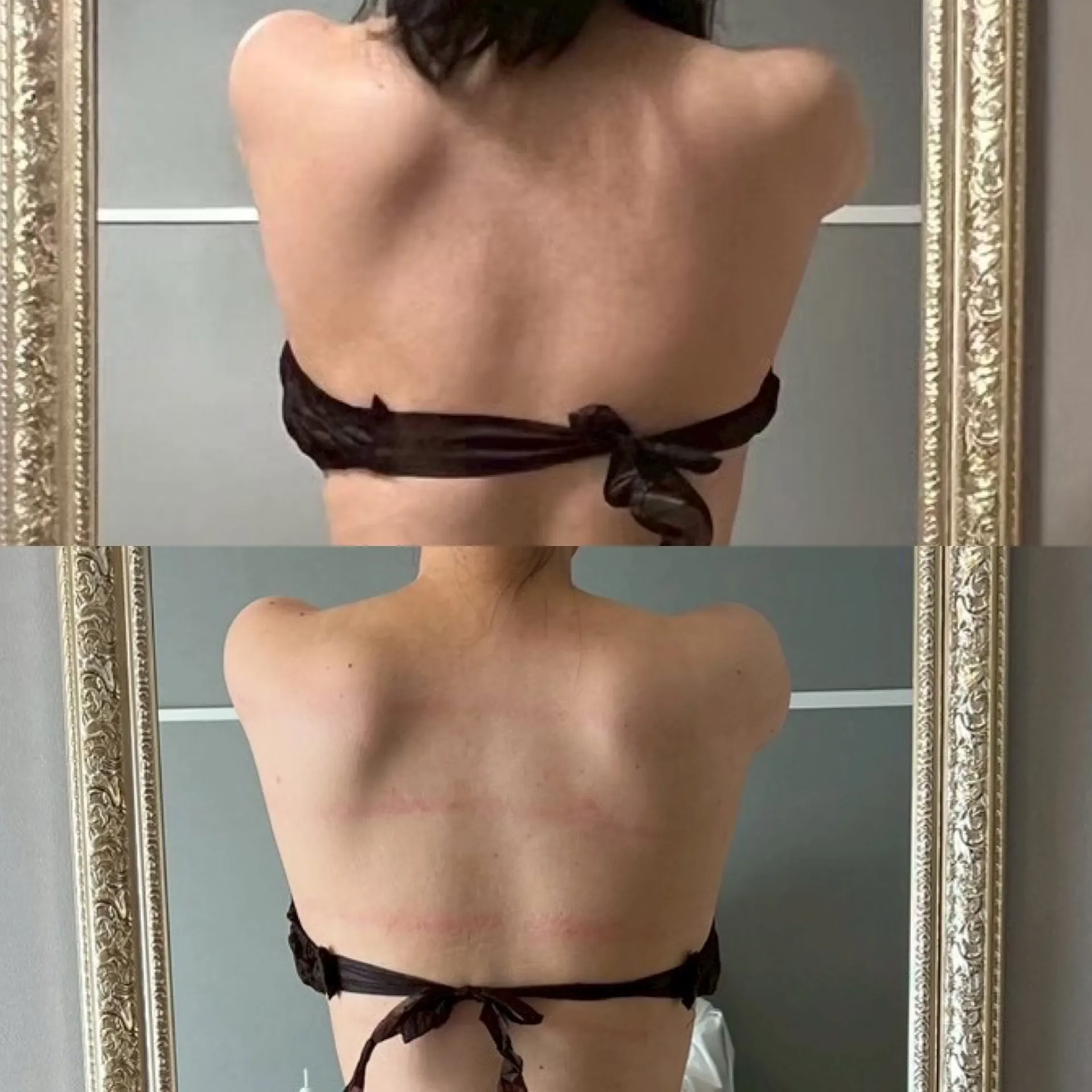 フィジオショット（背中脂肪溶解）