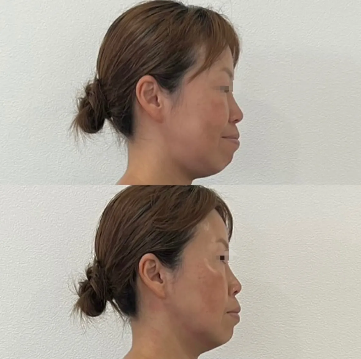 フィジオショット（顎関節症&肝斑）