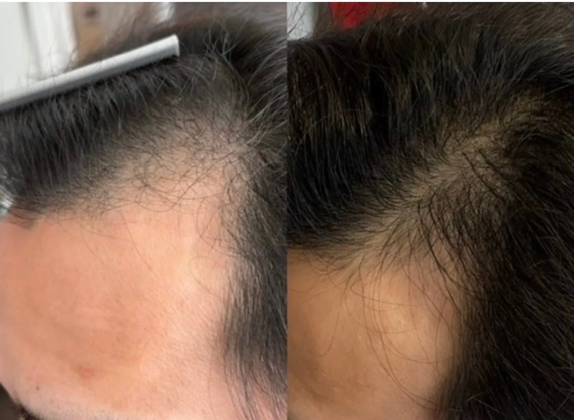 CURAIM育毛（３０代/M字）