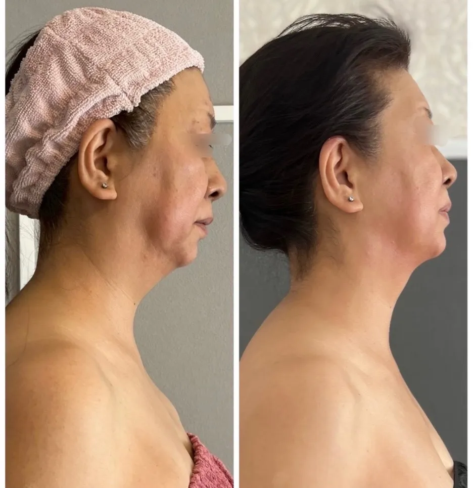 フィジオショット（美肌、小顔）