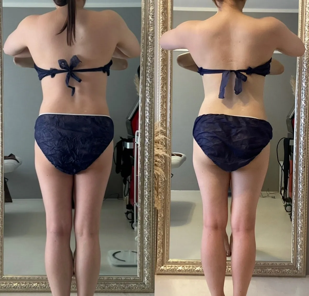 フィジオショット（腰周り脂肪溶解）