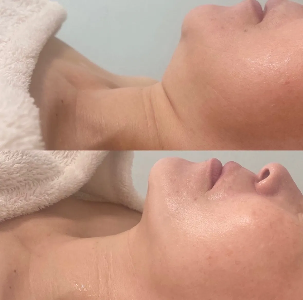 フィジオショット（フェイスライン）