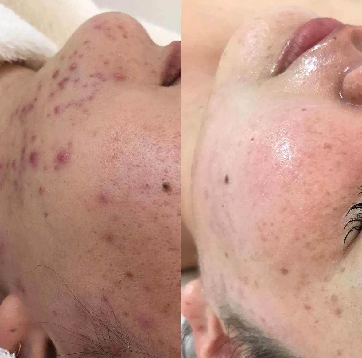 ニキビ改善コース（産後ニキビ）