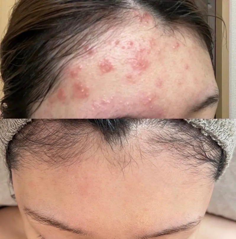 ニキビ改善コース