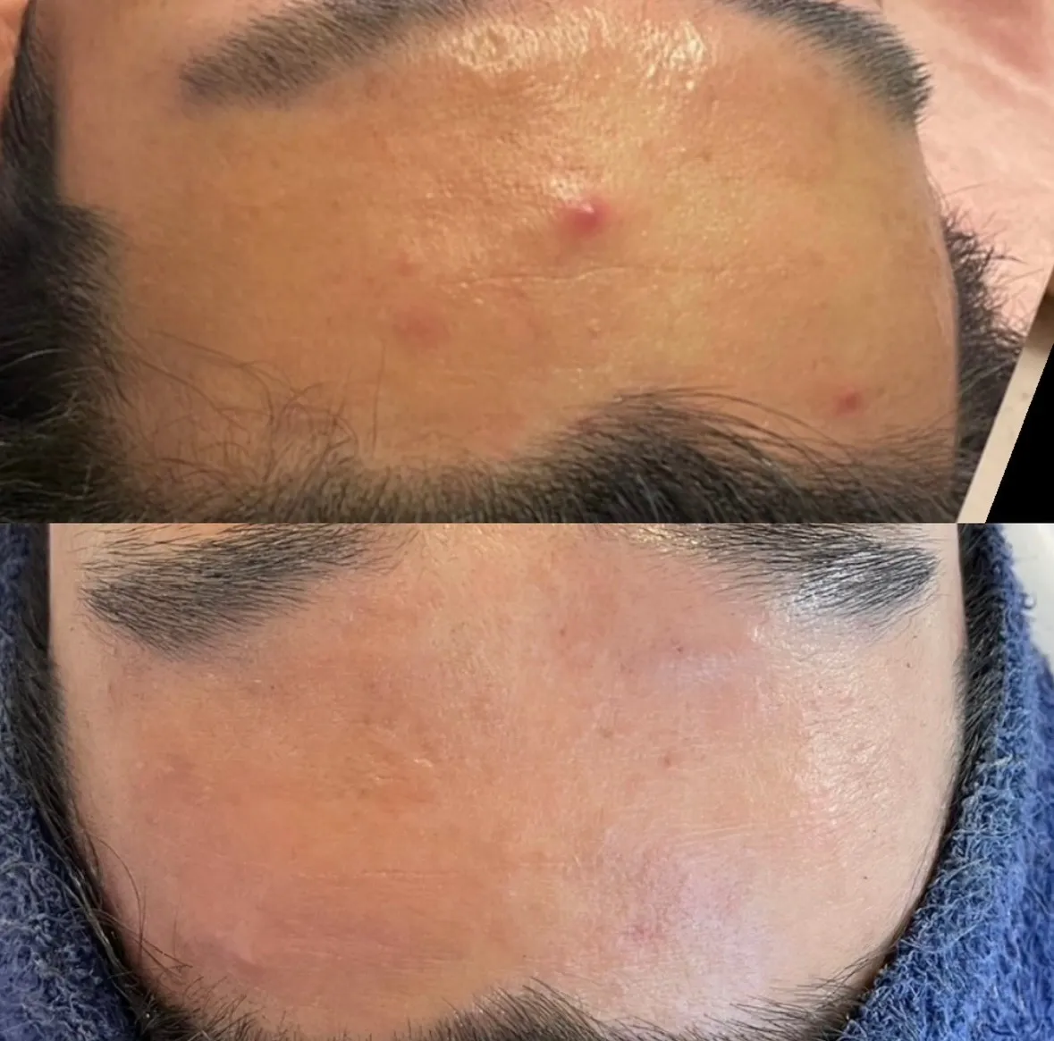 ニキビ改善コース