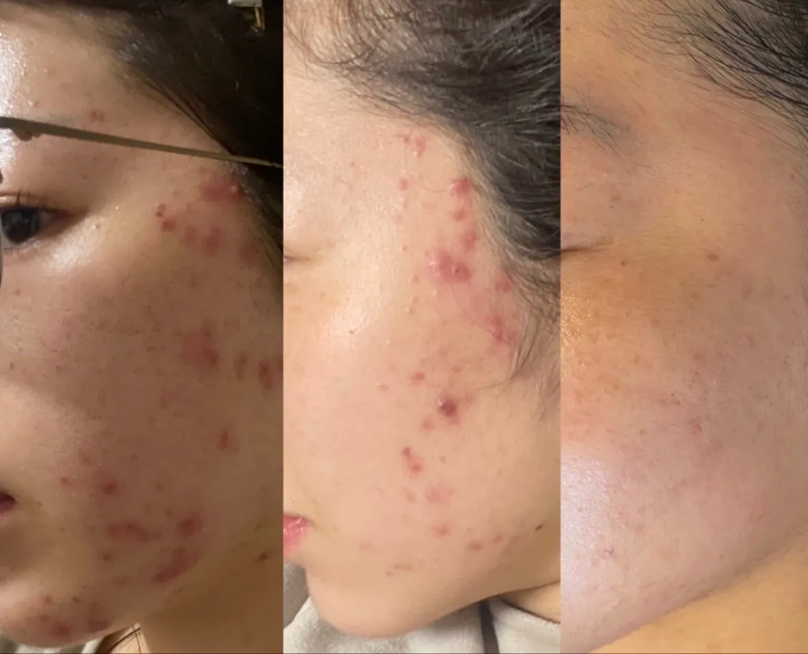 ニキビ改善コース