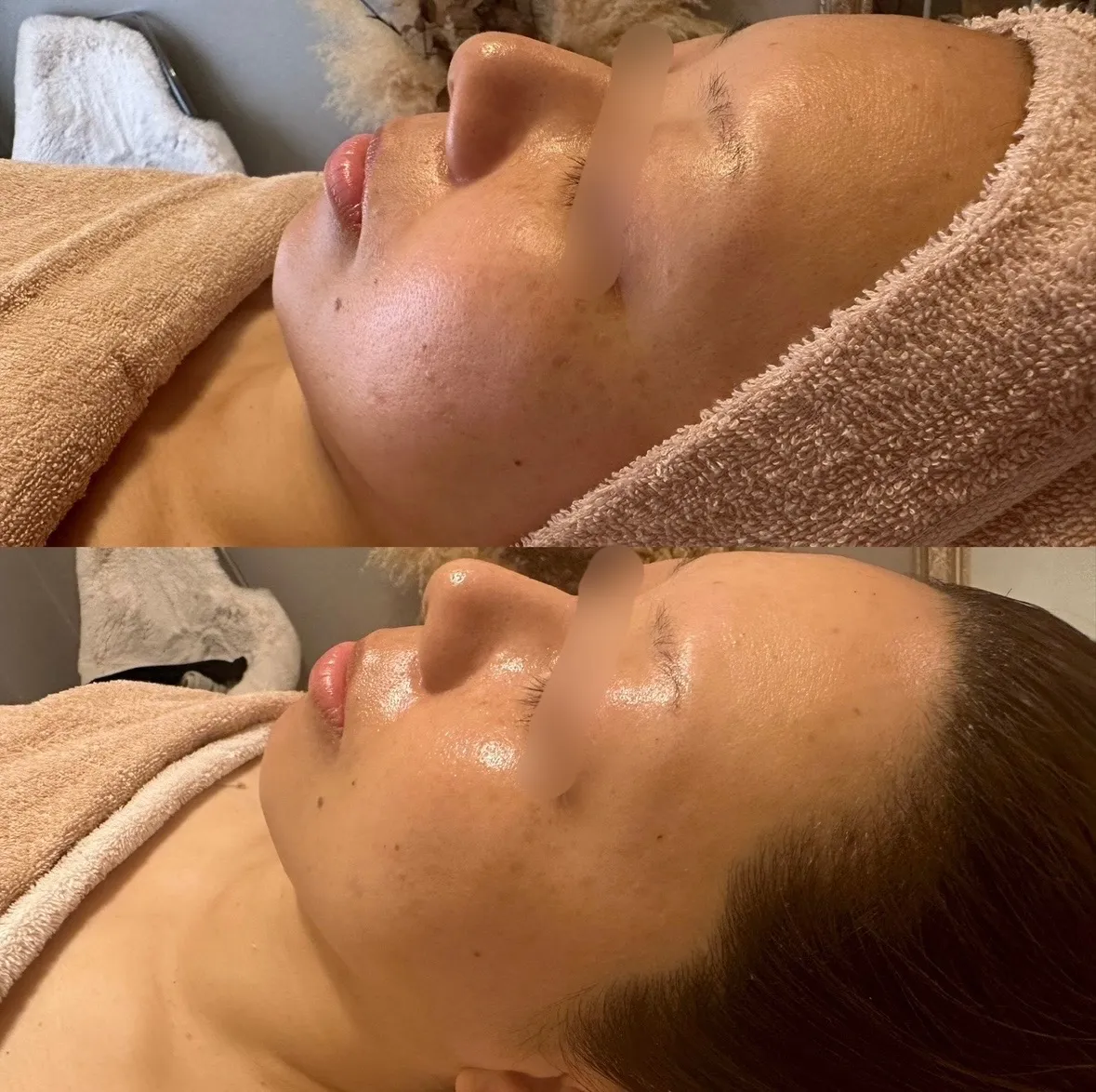 ハイドロスプラッシュ（毛穴洗浄）