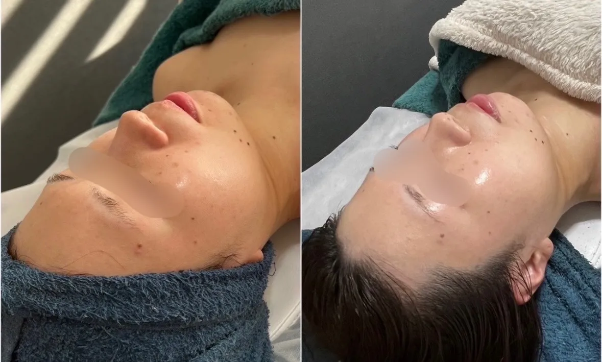 ブライダル美肌コース