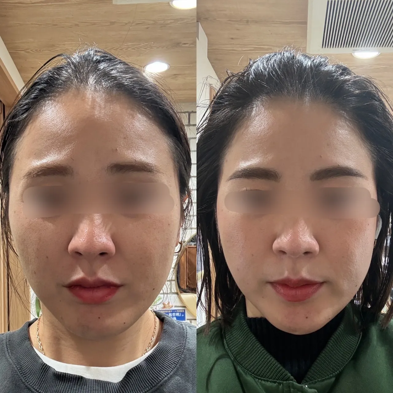 サプリメント育毛