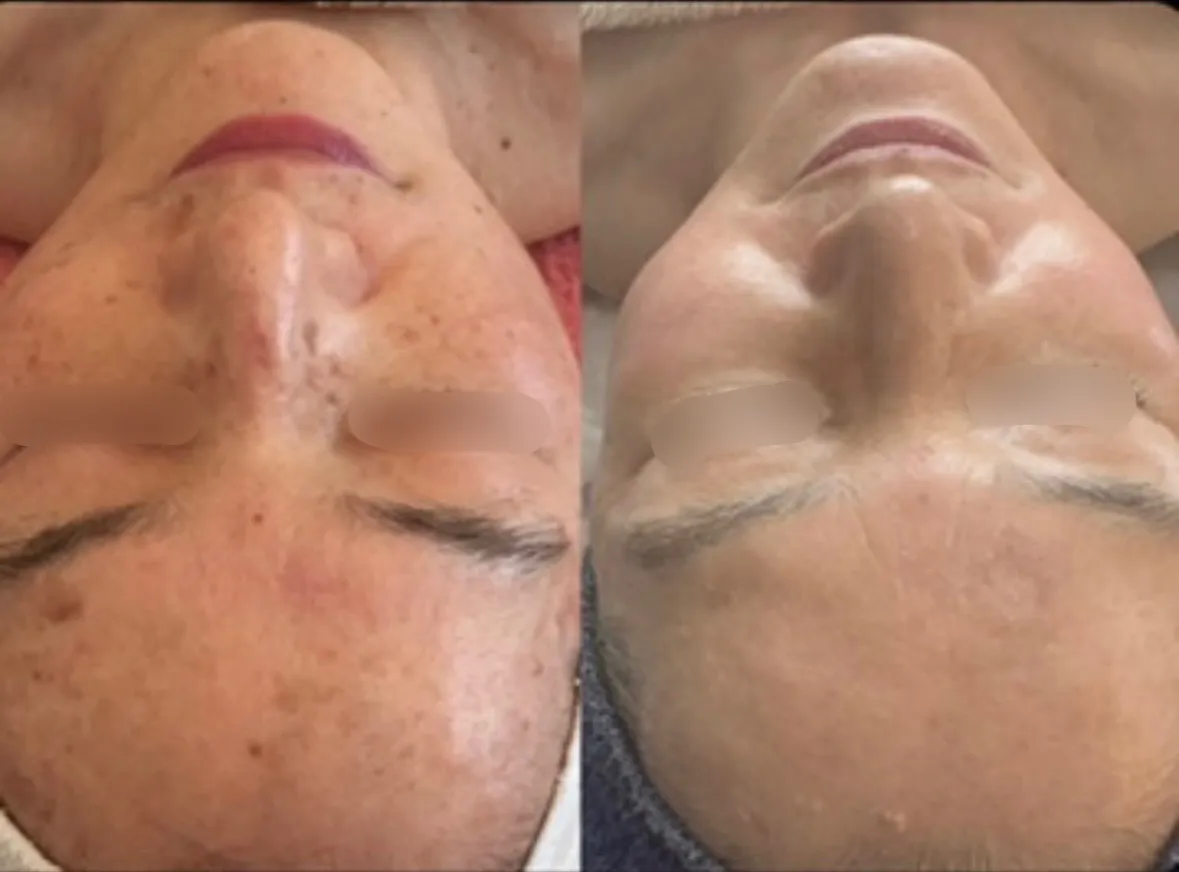 ハーバルピール