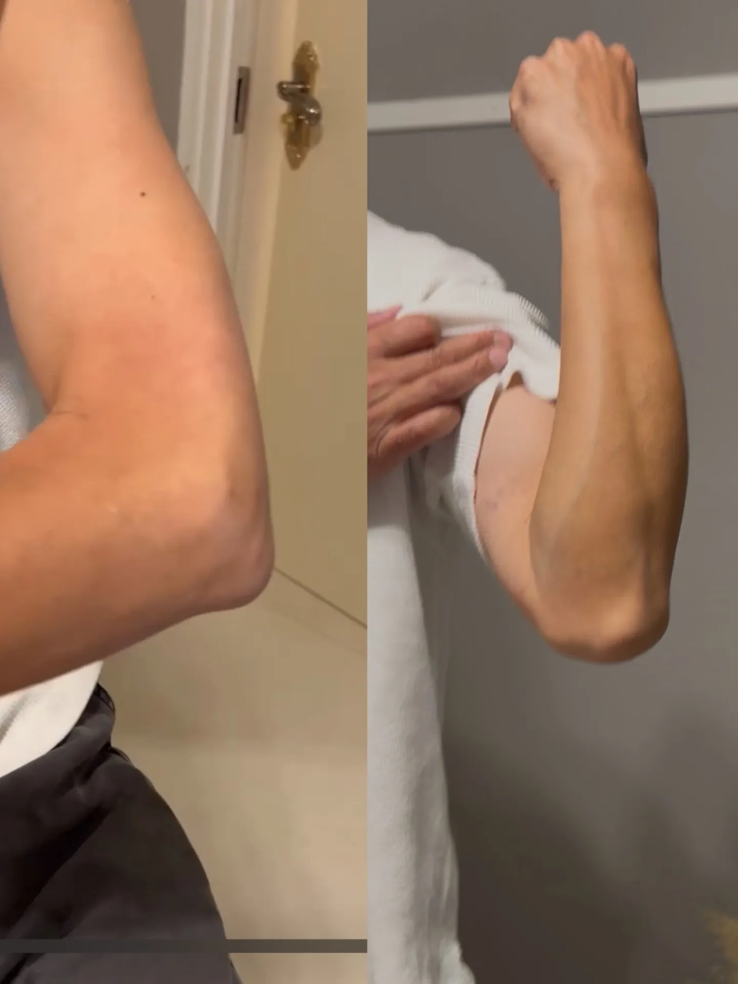 フィジオショット（筋膜アプローチ）